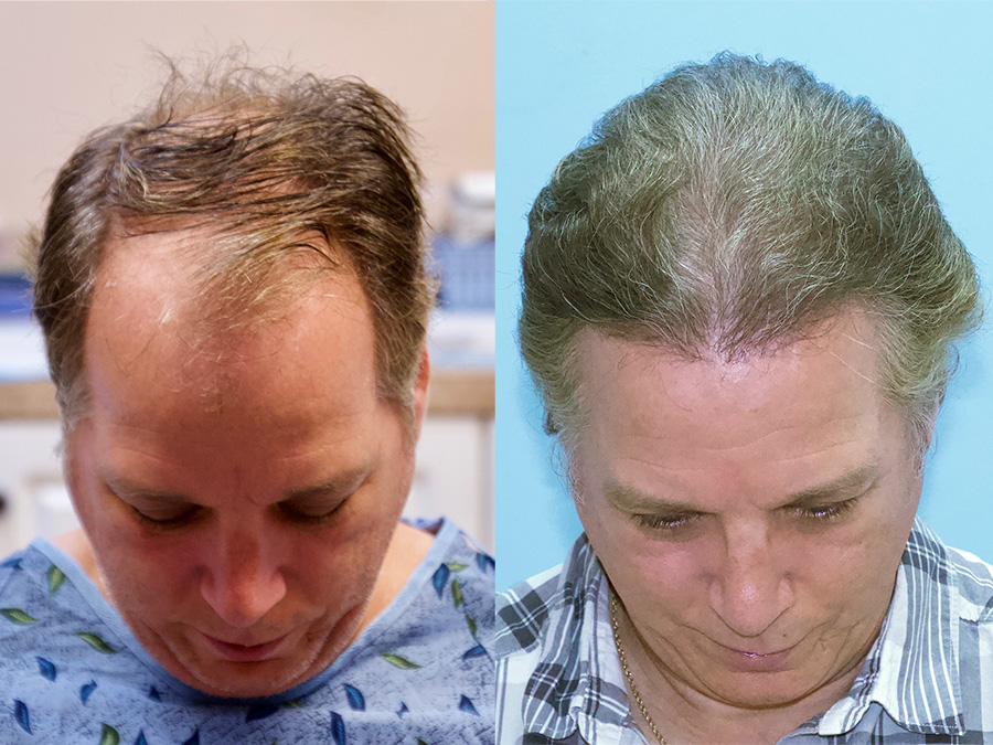 3500 Grafts Norwood Hair Loss Classification V Carolina Hair Surgery