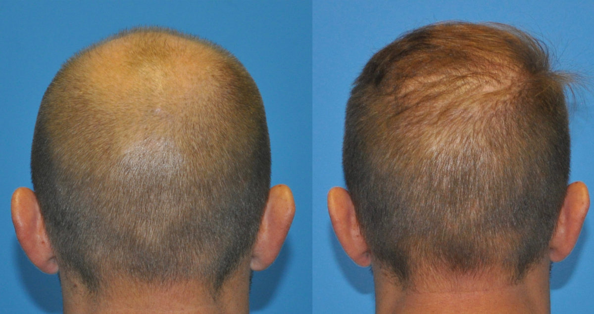 Two Day Fue Hair Grafts Case Study Carolina Hair Surgery