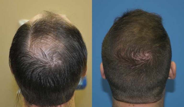 Case Study 3000 Grafts In One FUE Hair Transplant Session Carolina