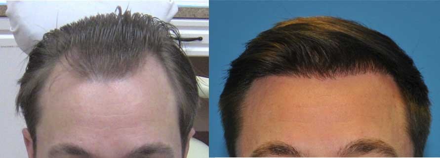 Hairline Before and 1 Year Post Op