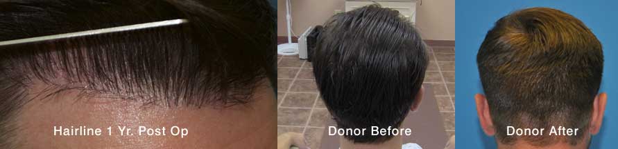 Hairline - 1 year post op and donor area before and 1 year after.