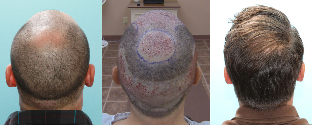 Rear View - Before - Immediately After FUE Hair Transplant and 1 Year Post Op.