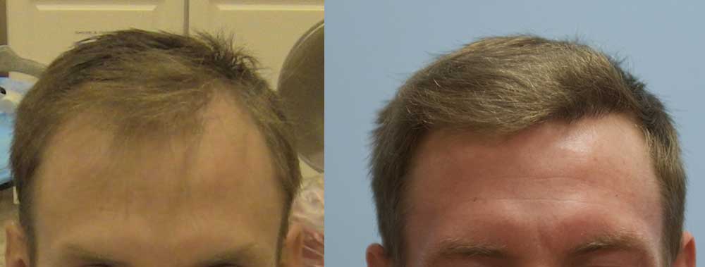Front View - before & 9 Months After 2000 FUE Grafts