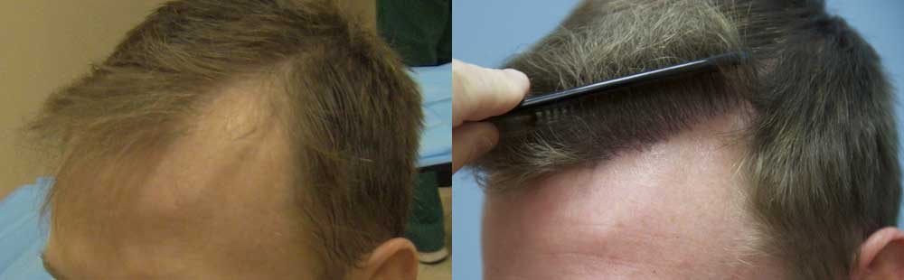 Left Side - Part View - 2000 FUE Hair Grafts.