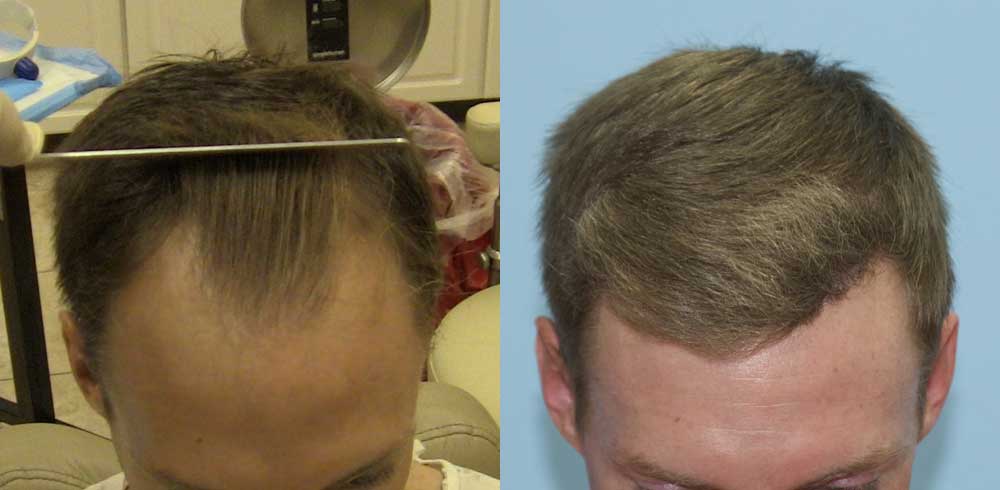 Top View - 2000 FUE Hair Grafts - Frontal Regions