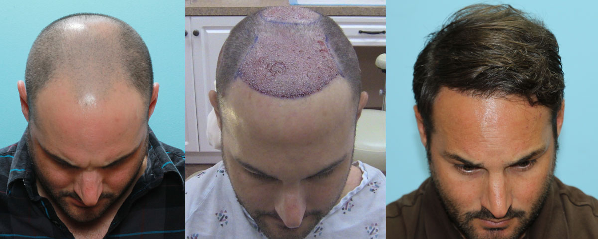 FUE Hair Transplant Case Study - 1 Year Before & After