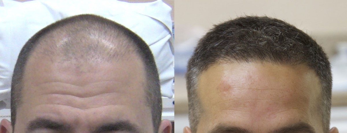 2500 hair grafts performed using follicular unit extraction (FUE). After - 6 months postop. front View