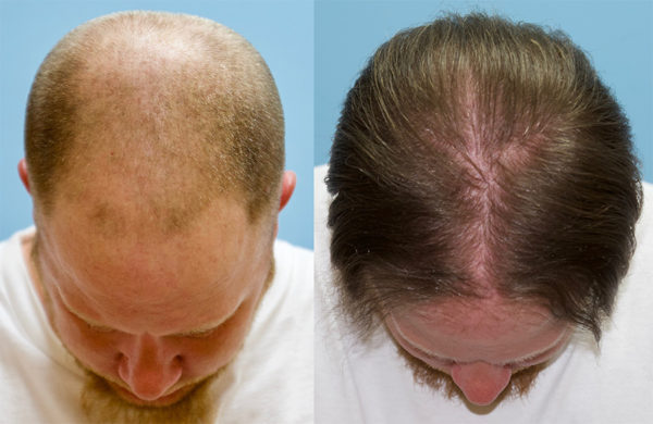 4000 Graft FUE Hair Transplant - Center Part - Carolina Hair Surgery