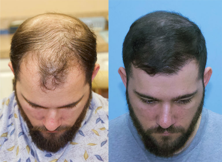 Fast Results After 5000 FUE Grafts Transplanted Carolina Hair Surgery