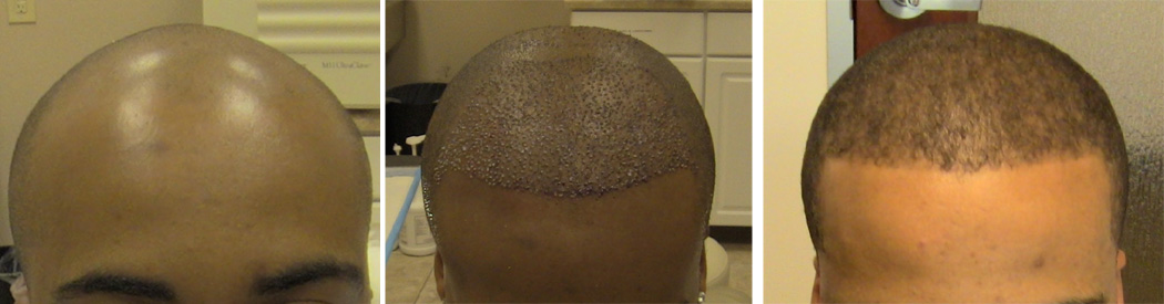 From Left to Right: Before FUE Hair Transplant, Immediately after the first FUE hair transplant session and 6 months after procedure.