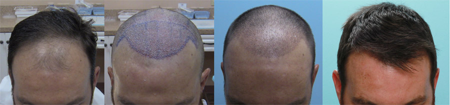 L-R: Before - Immediately After surgery - 1 week Post Op - 1 Year After FUE Hair Restoration