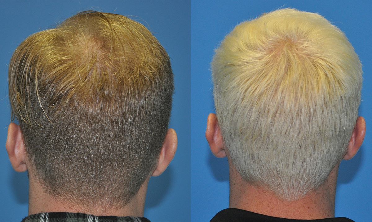 Crown thinning prior. Hair has thickened due to finasteride hair maintenance protocol.