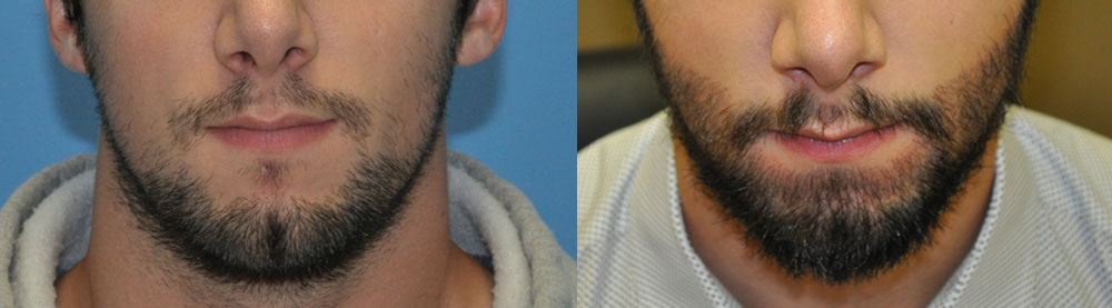 Beard Hair Transplant - Carolina Hair Surgery