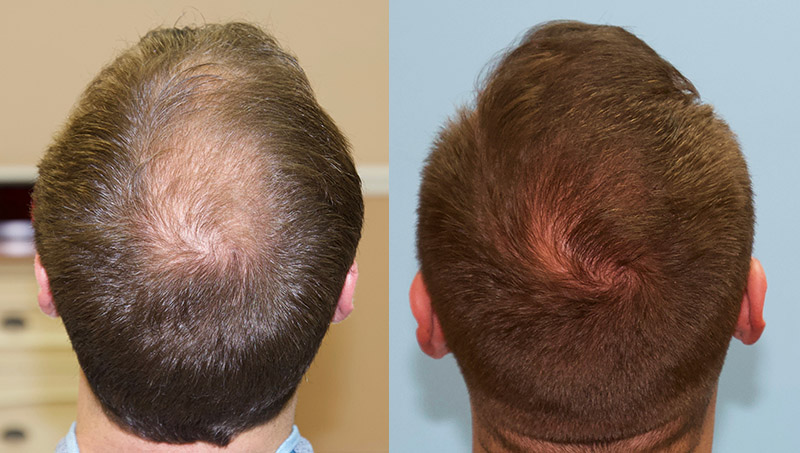 Crown Hair Loss Case Study - Carolina Hair Surgery