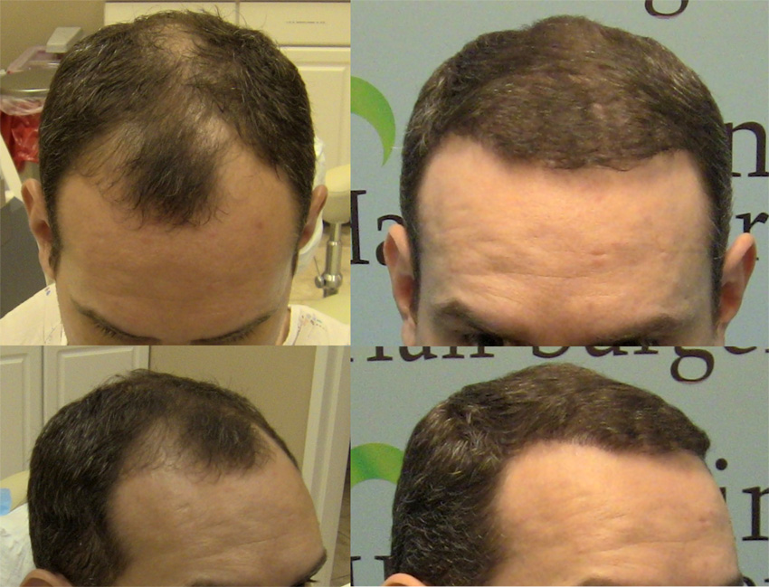 Frontal FUE Hair Transplant - 2000 Hair Grafts - Carolina Hair Surgery