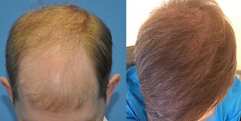 7000 Graft FUE Hair Transplant - Carolina Hair Surgery