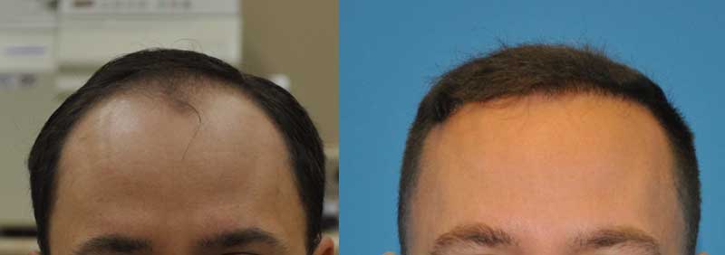Front hairline view before and 6 months after 3000 graft FUE procedure.