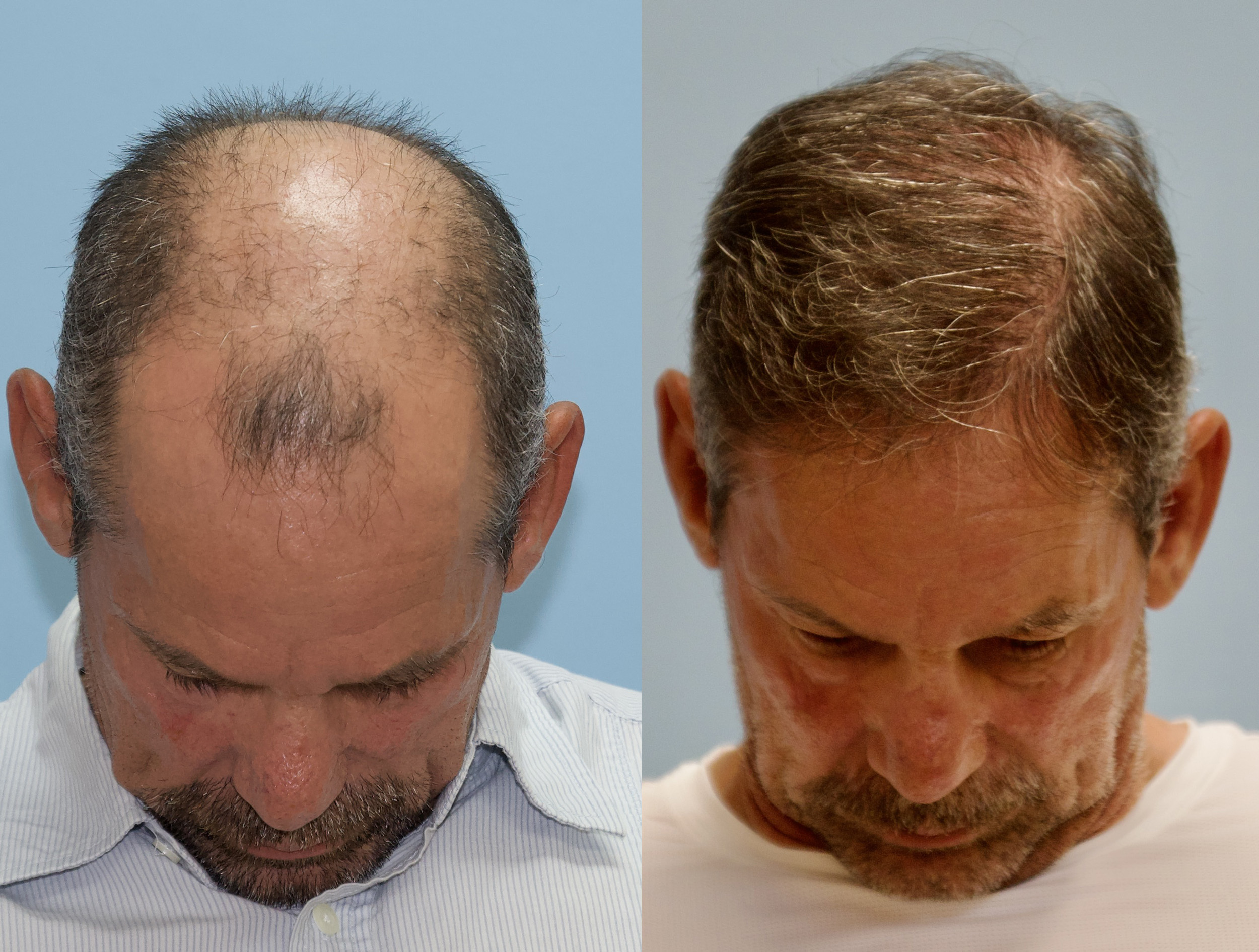 Hair Transplant Before And After 5000 Grafts
