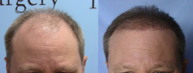 5000 Graft FUE Hair Transplant Update - 6 Months - Carolina Hair Surgery