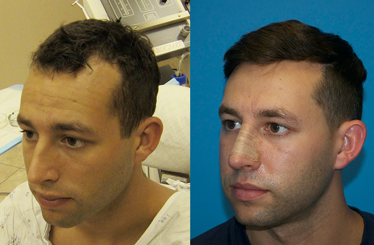 Left side view - before and 6 months after 1500 FUE hair grafts.