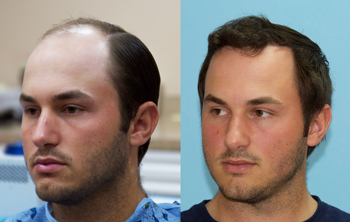 Left side - part view. 3000 FUE graft hair transplant.