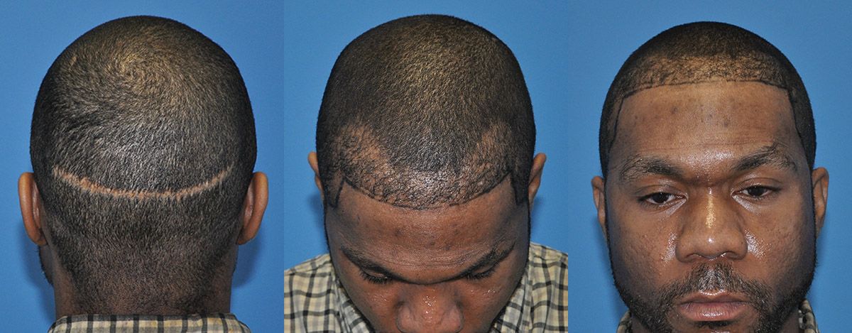 FUE Donor Scar Revision and Additional Recipient Densification - Carolina  Hair Surgery