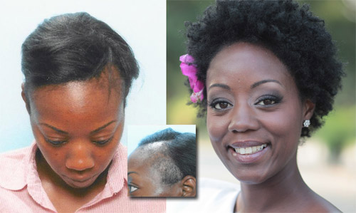 African American Female Hair Transplant Testimonial - Carolina Hair Surgery  | Charlotte, NC | Charleston, SC