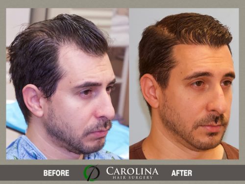 Hair Transplant Before & After Photos