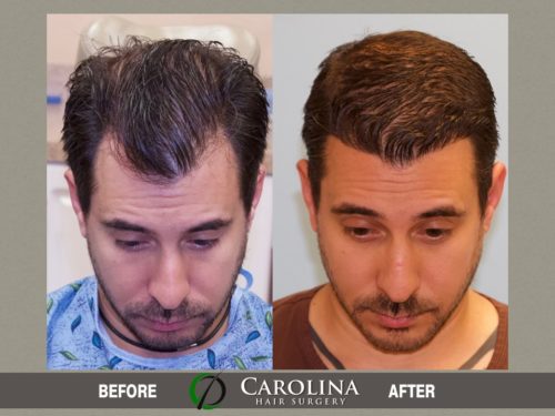Hair Transplant Before & After Photos