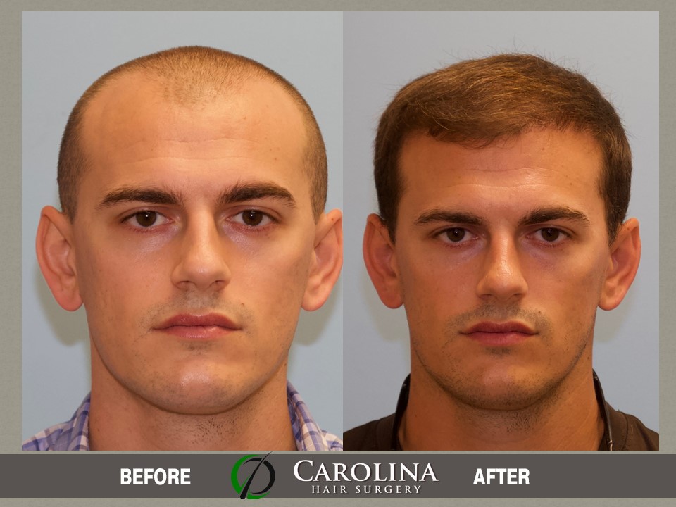 hair transplant front view