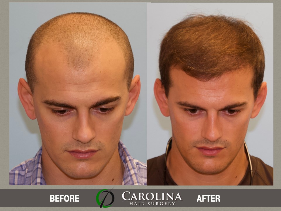 26 Year Old Male With Norwood Class 4 Hair Loss - Carolina Hair Surgery