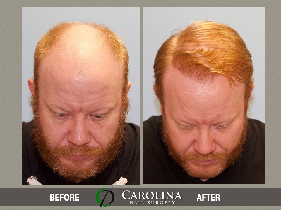 hair restoration cost in usa