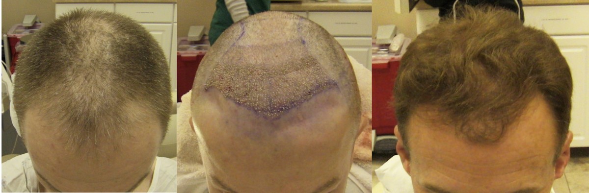L-R: Before, Immediately After Surgery and 1 Year After FUE Hair Restoration