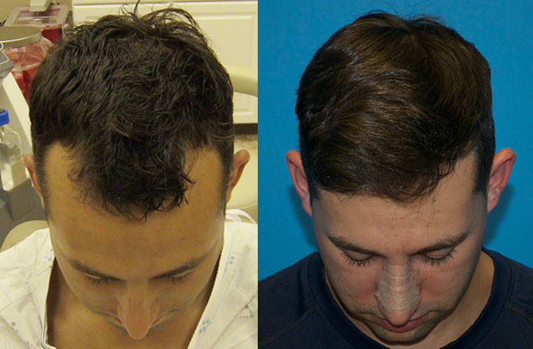 Top view - before and 6 months after 1500 FUE hair grafts.