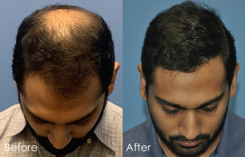 Top FUE ONLY Hair Transplant Surgeon | Charlotte NC, Charleston, SC