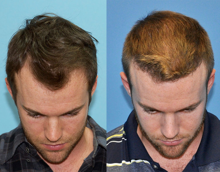 25 year old Male Hairline Restoration - Carolina Hair Surgery