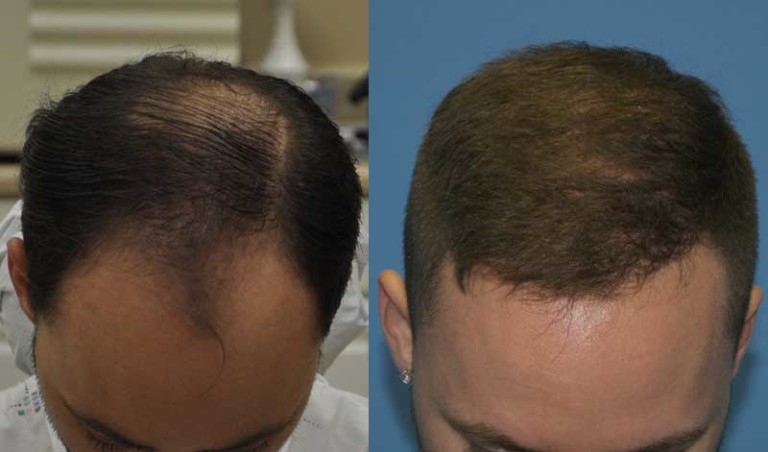 Case Study 3000 Grafts in One FUE Hair Transplant Session - Carolina ...