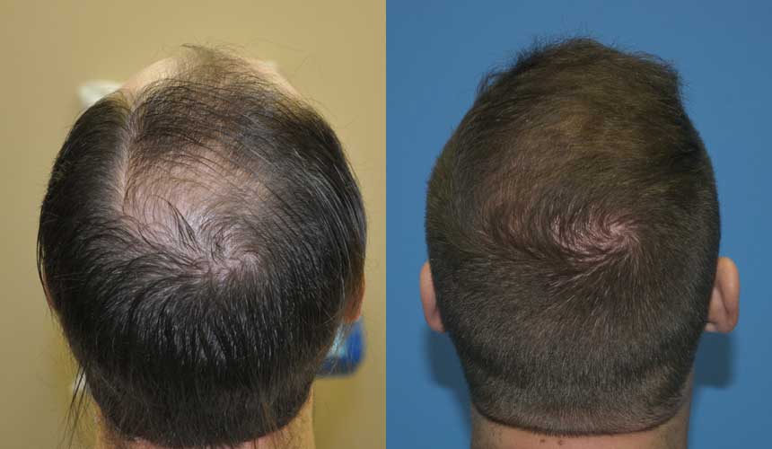 Top back view before and 6 months after 3000 grafts. Hair regrowth has provided uniform density.