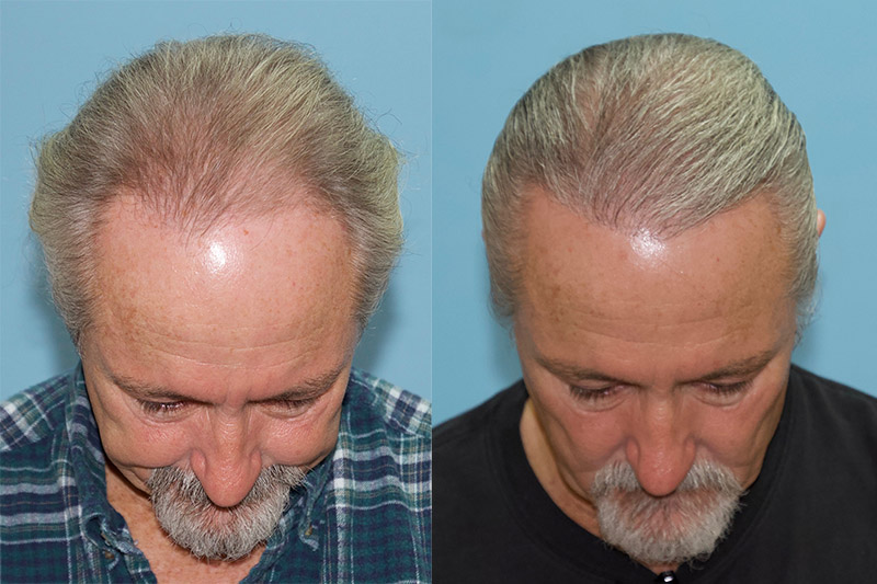 Gray Hair FUE Hair Transplant - Carolina Hair Surgery