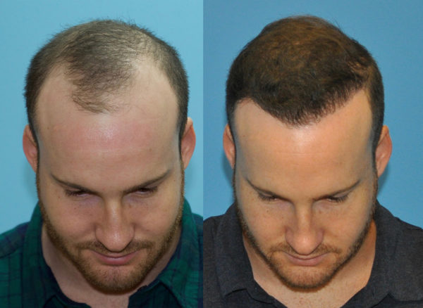 2000 FUE Grafts - Case Study - Norwood Class III - Carolina Hair Surgery