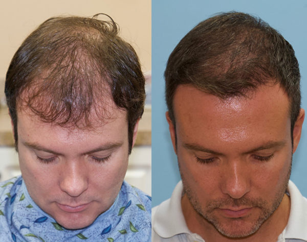 FUE Hair Transplant Case Study - 2 Day - 3500 Grafts - Carolina Hair ...