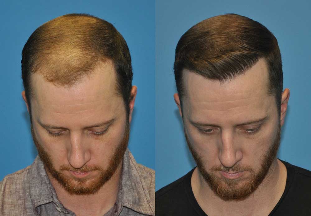 Before and 10 months after 2000 FUE grafts. Top view.