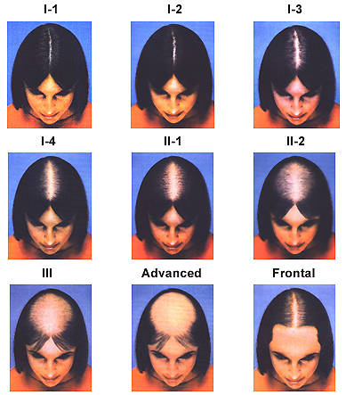 The Ludwig Scale for Women's hair loss.